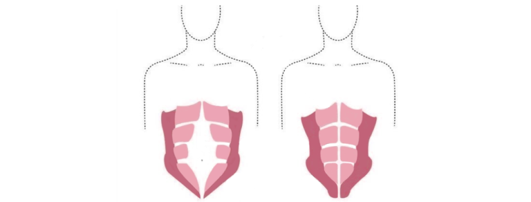diastasis abdomial