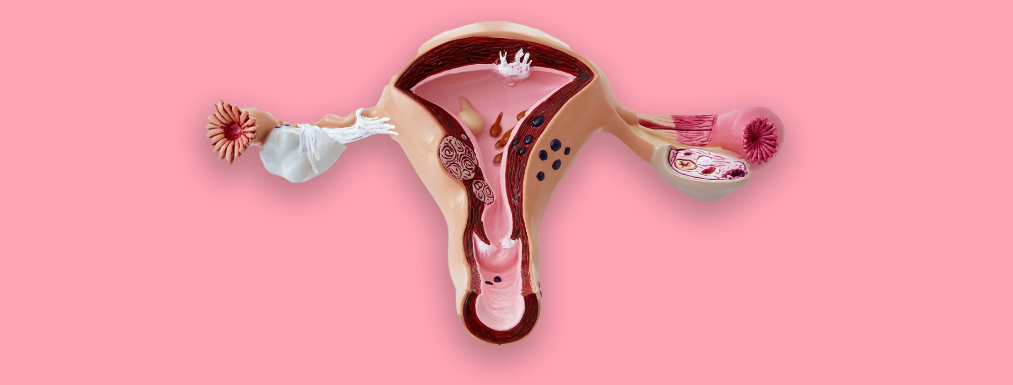 Sintomas da síndrome pré-menstrual