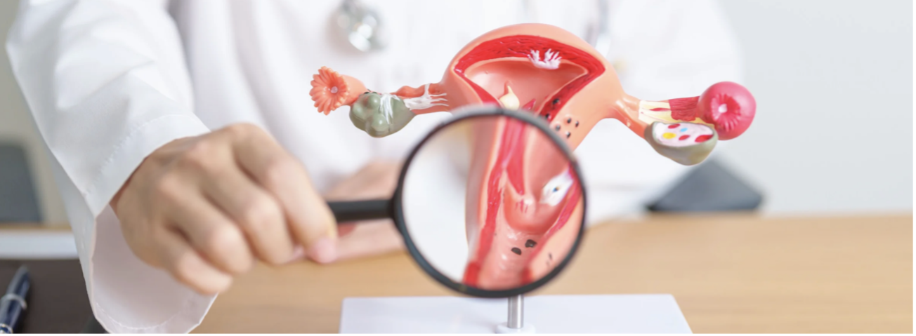síndrome de ovario poliquístico y endometriosis